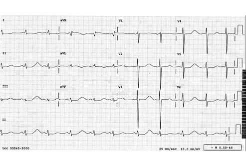 Prolonged Qt Interval. The QT interval (black bar) is