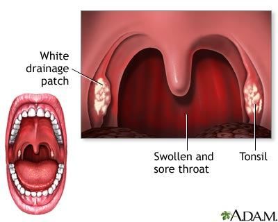 Strep throat?